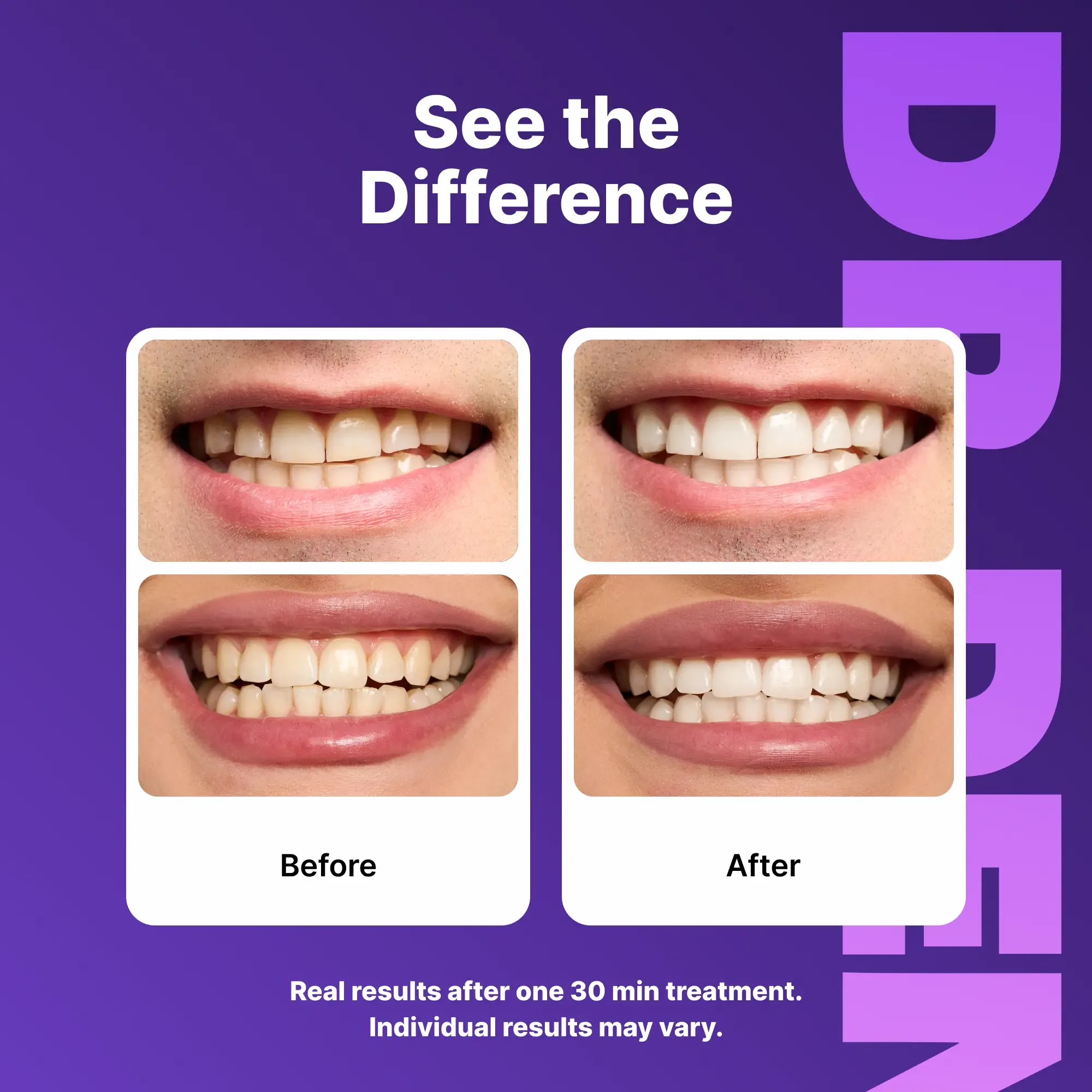 Purple Teeth Whitening Strips 7/21 Whitening Sessions Safe for Gold Does Not Cause Teeth Sensitivity Peroxide Free